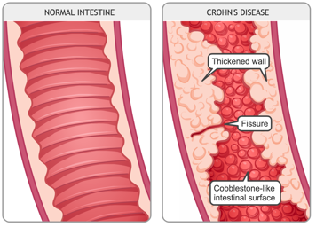 Close-up of a normal intestine and close-up of an intestine with Crohn’s disease